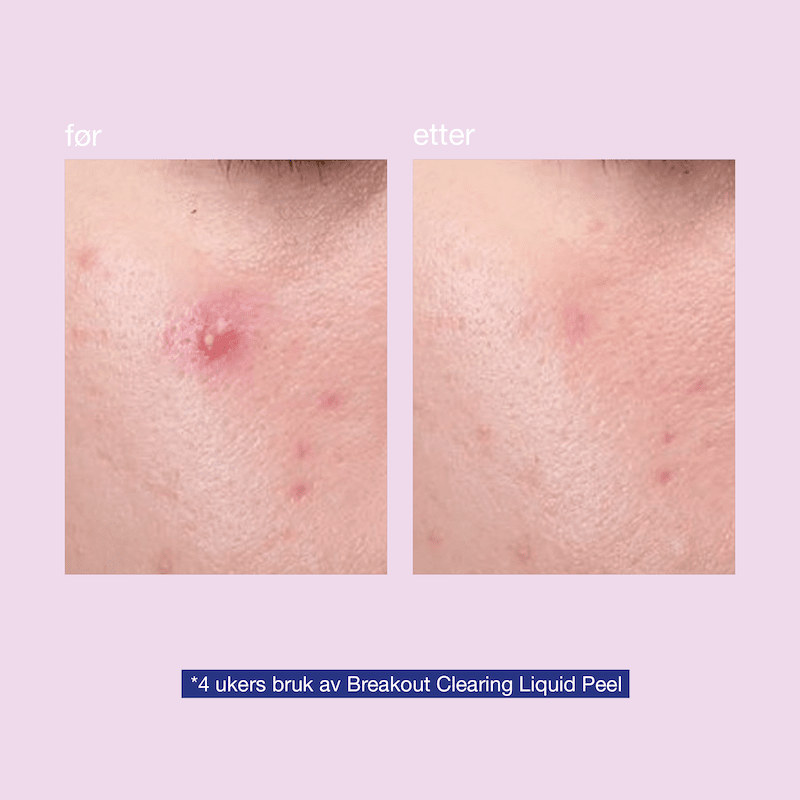 Breakout Clearing Liquid Peel 30ml